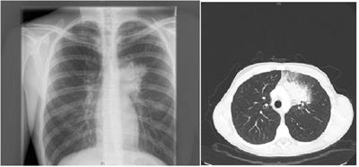 Genetic Diagnostic Elucidation of a Patient With Multiorgan Granulomas, Facial Peculiarities, and Psychomotor Retardation